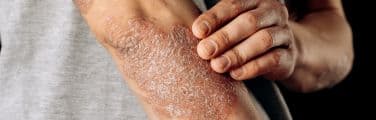 Psoriasis Treatment