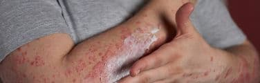 Skin Conditions