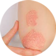 Psoriasis