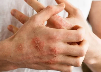 Eczema