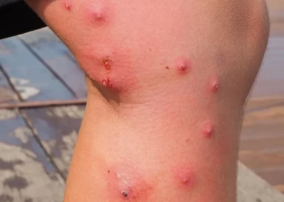 Insect Bites