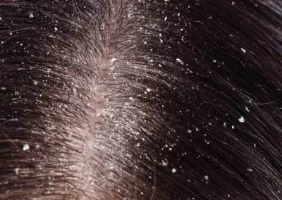 Dandruff