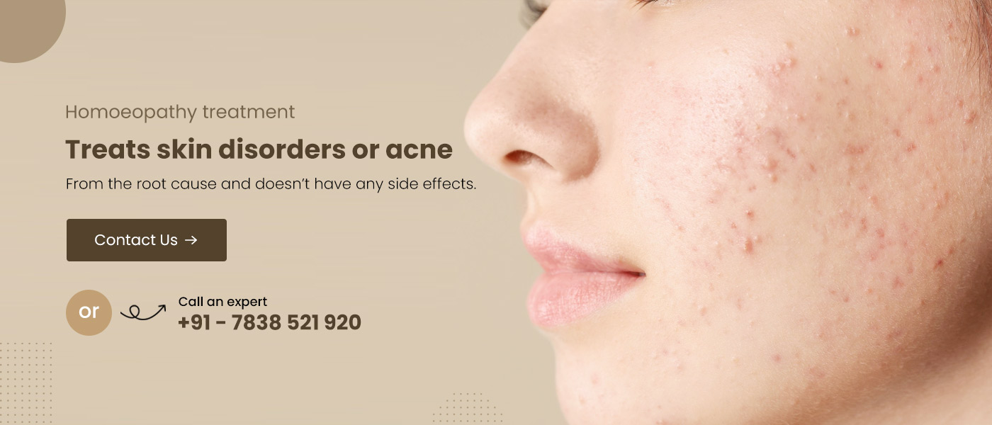 homeopathic-treatment-for-acne