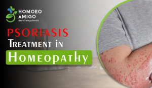 Psoriasis Treatment in Homeopathy: A Natural Approach to Find Relief