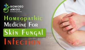 Best Homeopathic Medicine For Skin Fungal Infection