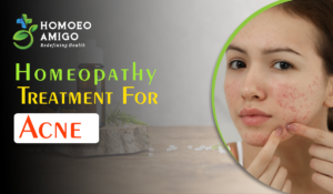 Homeopathic Treatment for Acne – Achieving Clear Skin Naturally